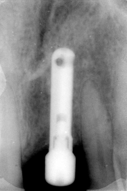 Implant